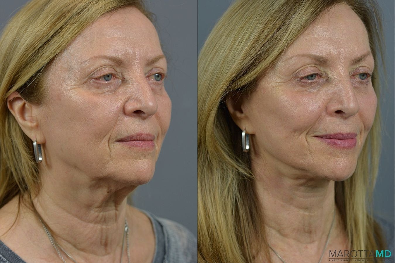 Facelift Neck Lift Before & After
