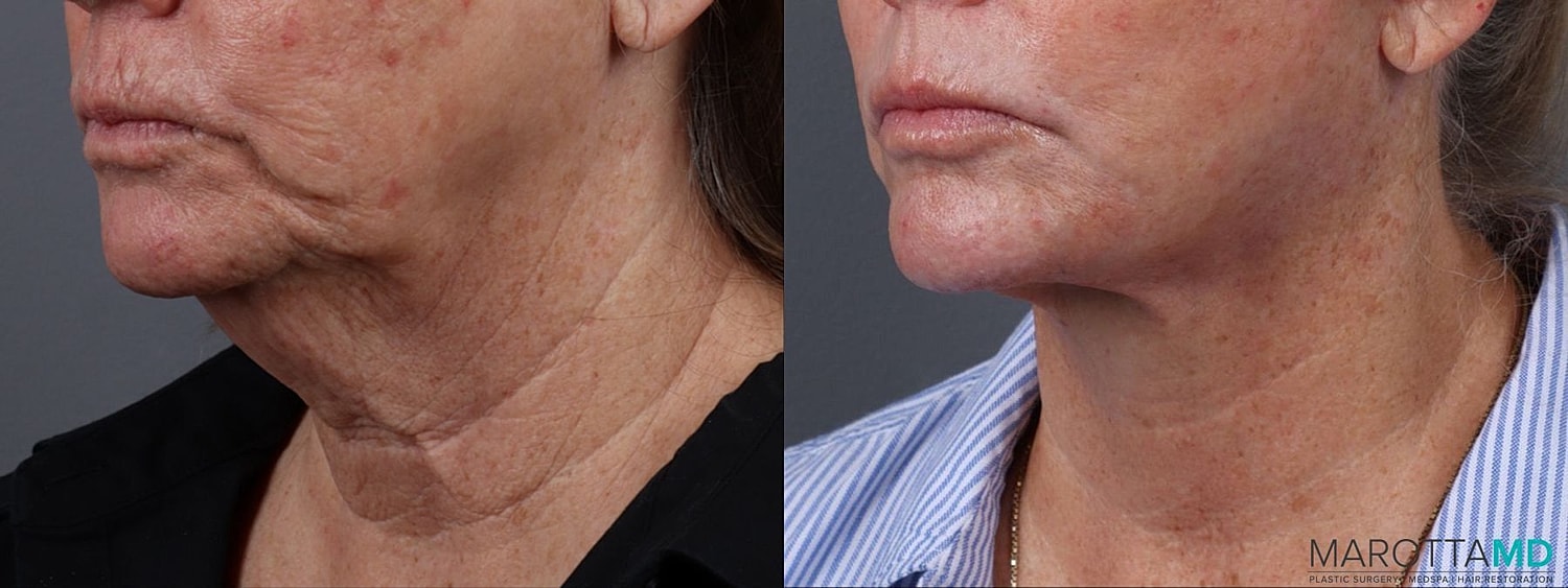 Facelift Neck Lift Before & After