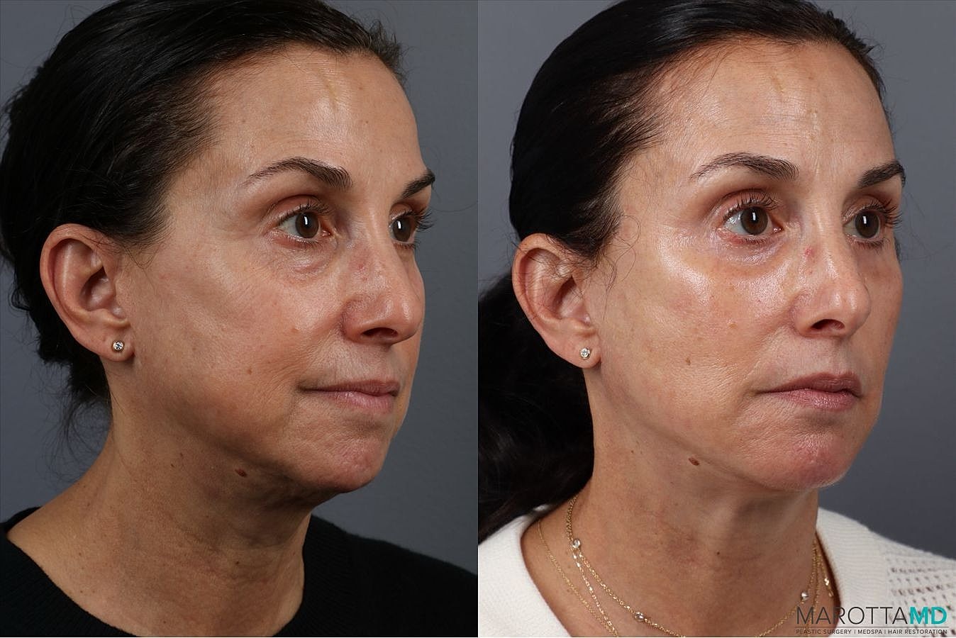 Facelift Neck Lift Before & After