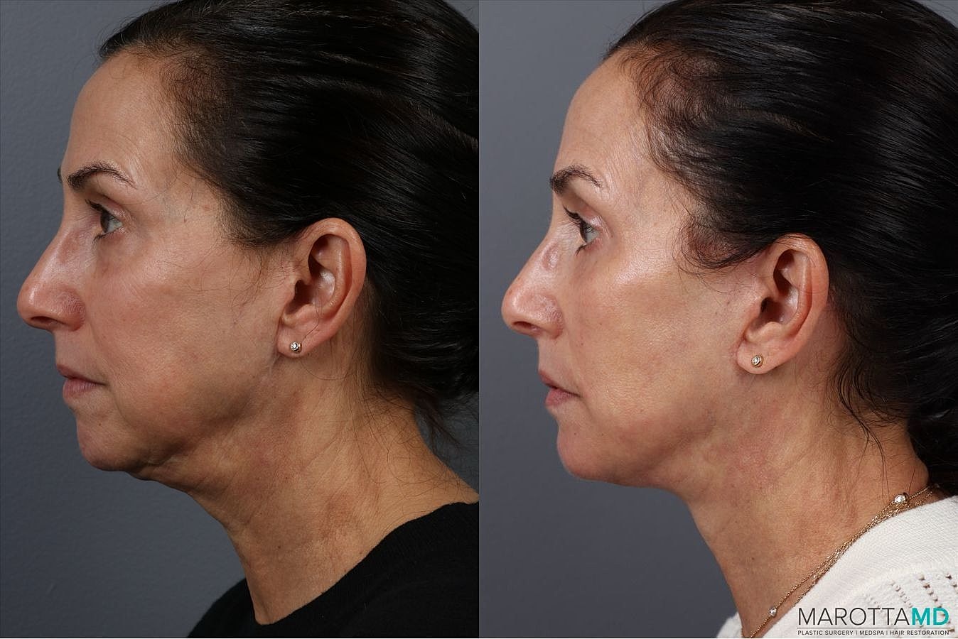 Facelift Neck Lift Before & After