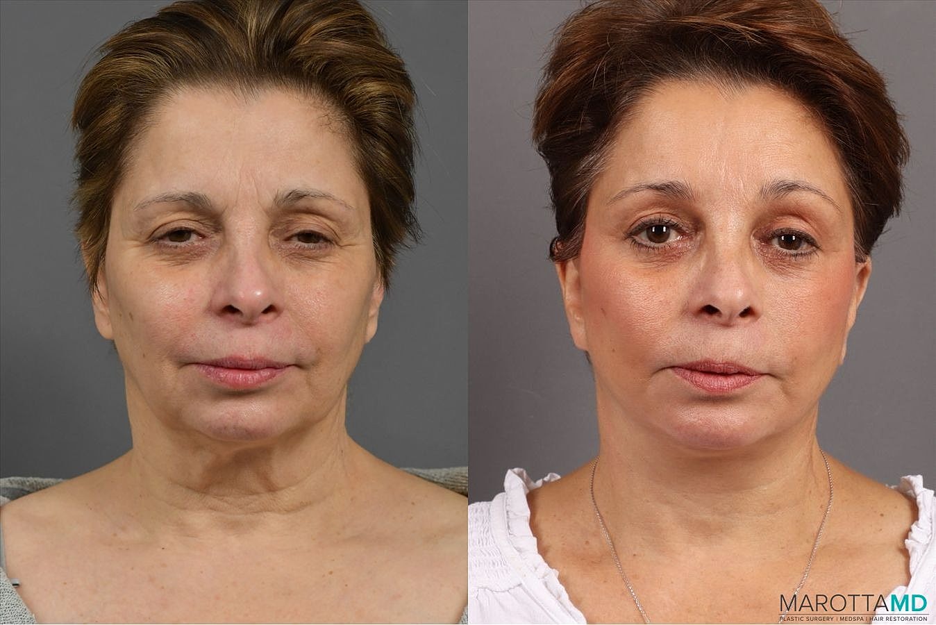 Facelift Neck Lift Before & After