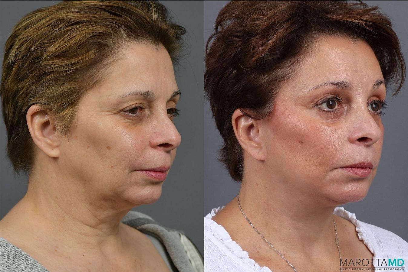 Facelift Neck Lift Before & After