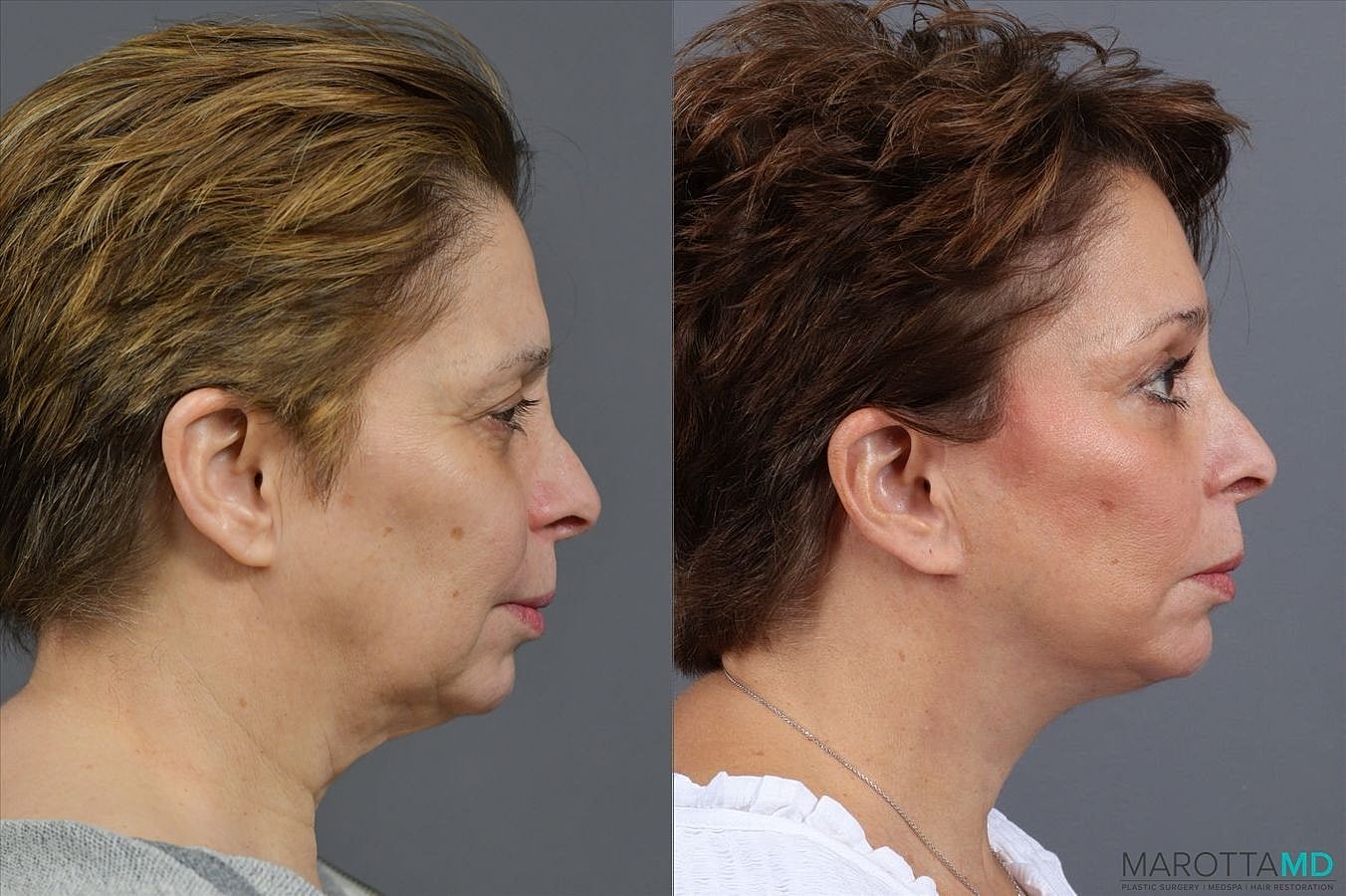 Facelift Neck Lift Before & After