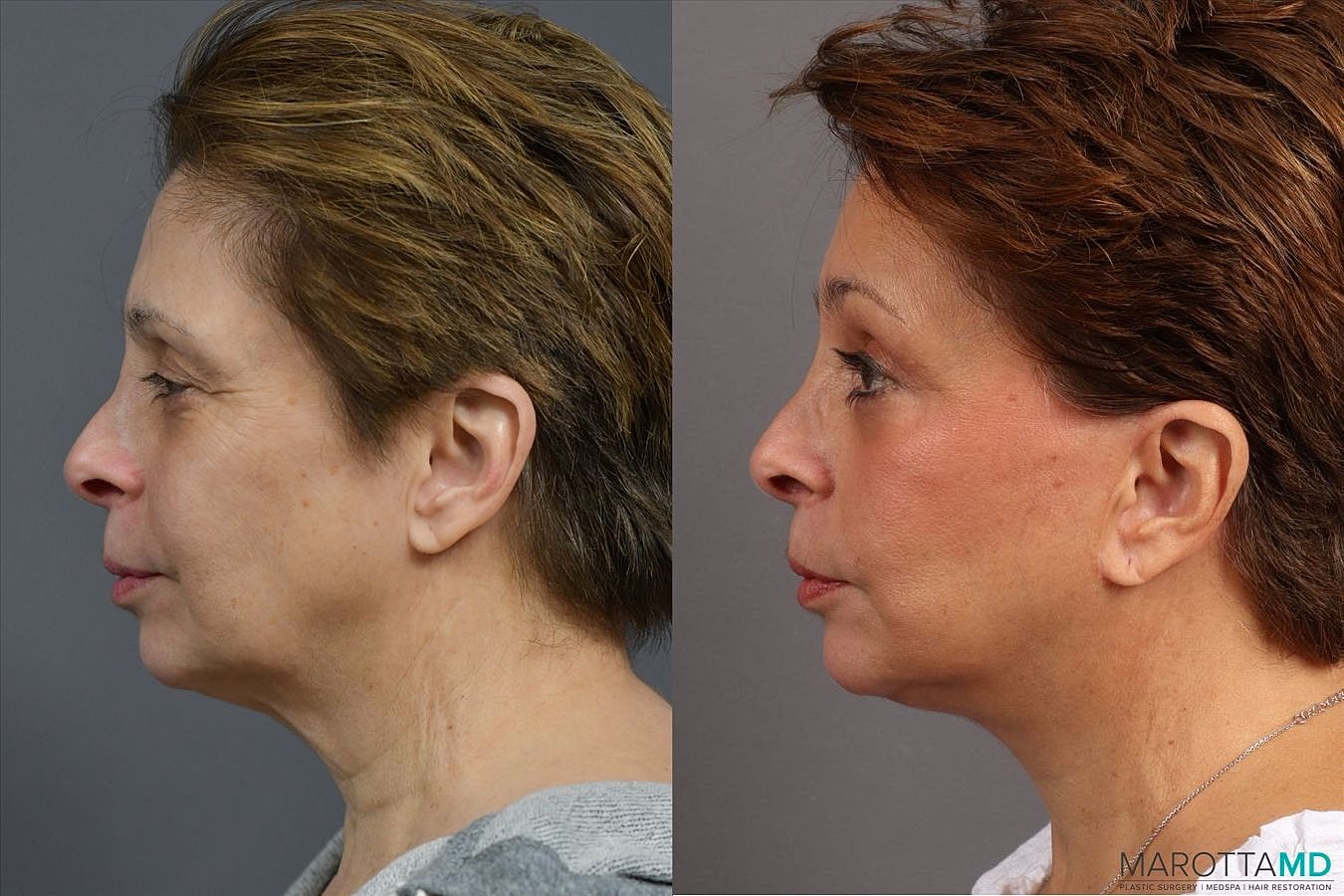 Facelift Neck Lift Before & After
