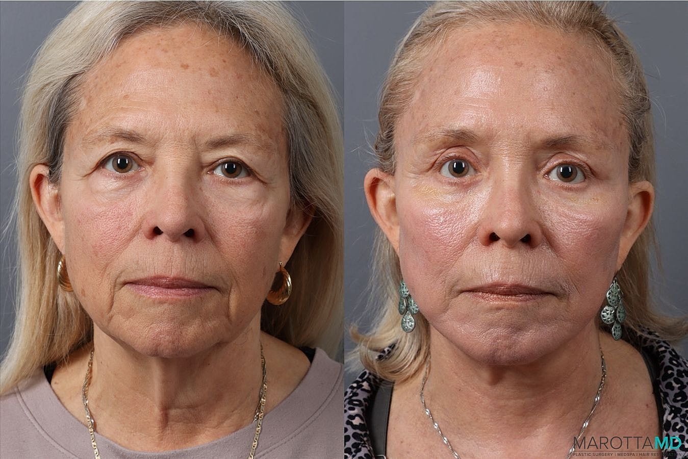 Facelift Neck Lift Before & After