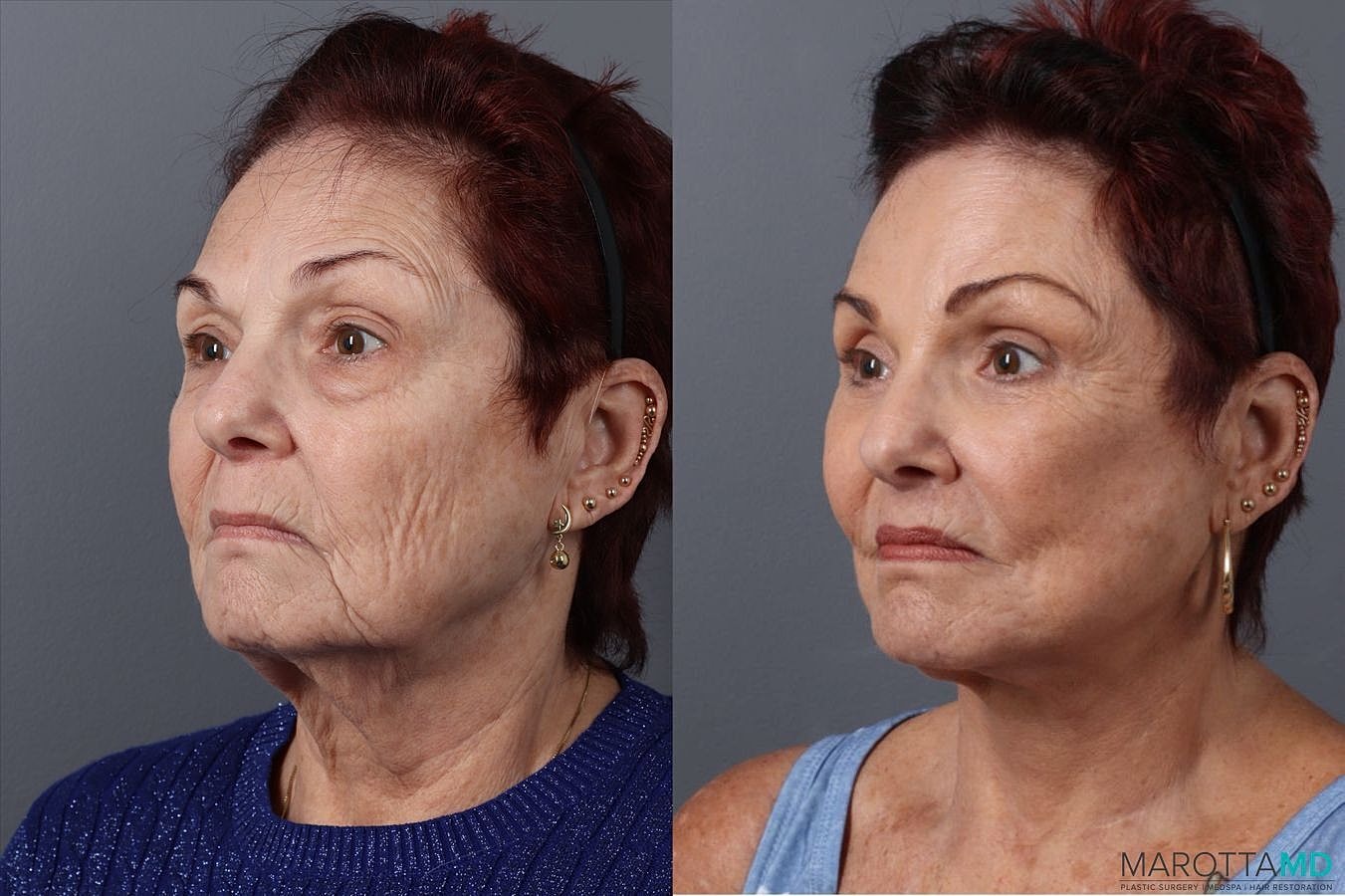 Facelift Neck Lift Before & After