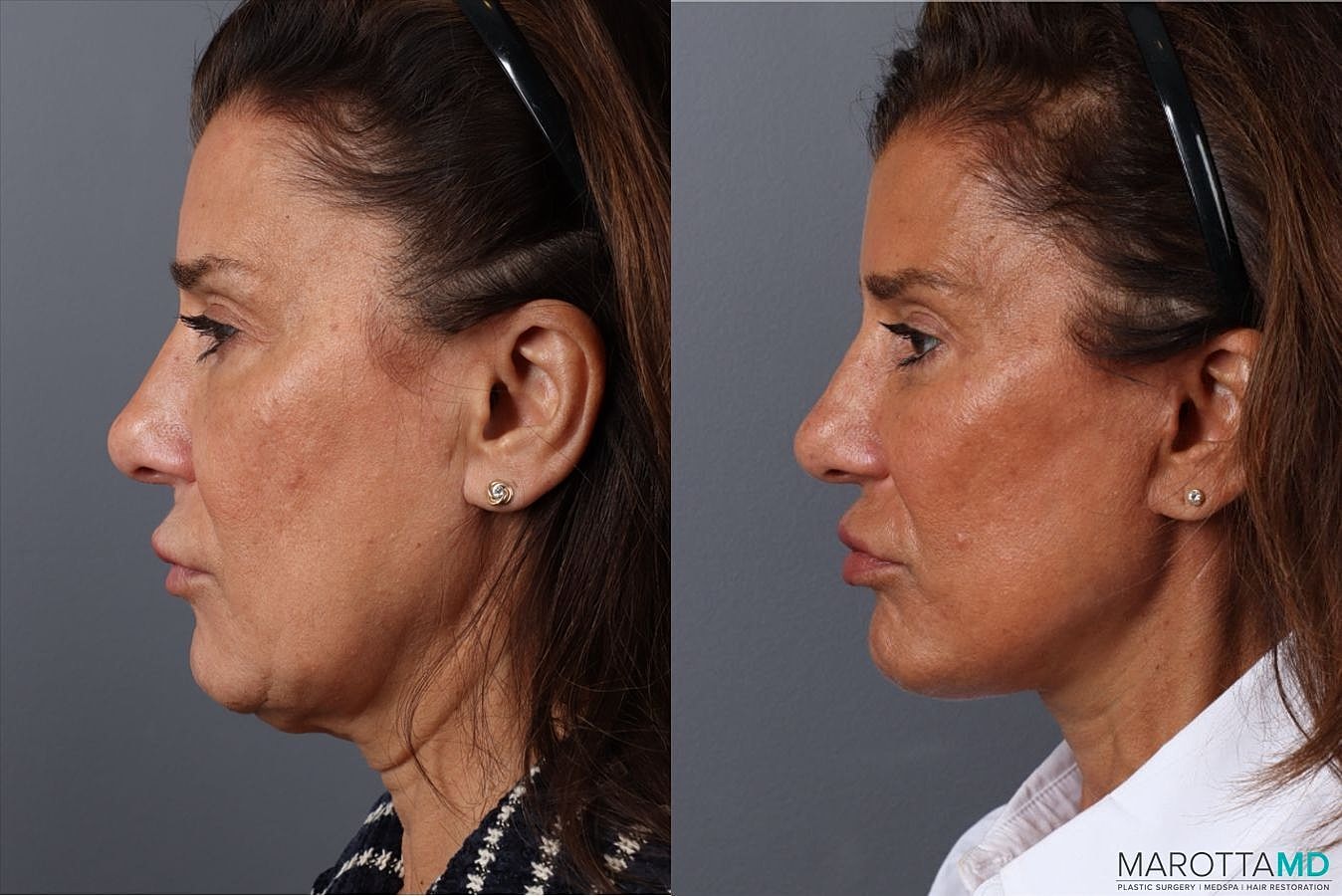 Facelift Neck Lift Before & After