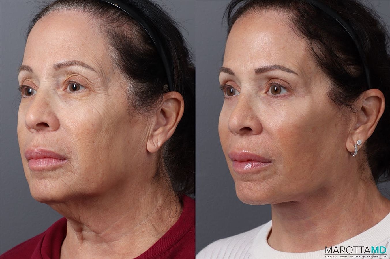 Facelift Neck Lift Before & After