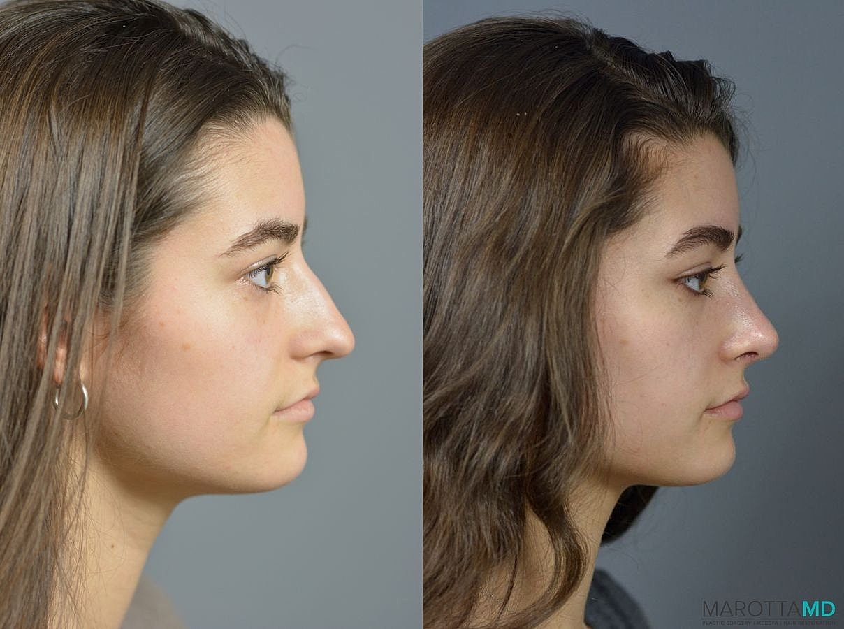 Nose Surgery Before & After