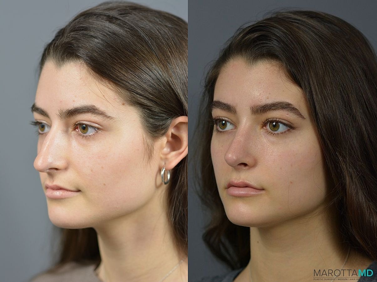 Nose Surgery Before & After
