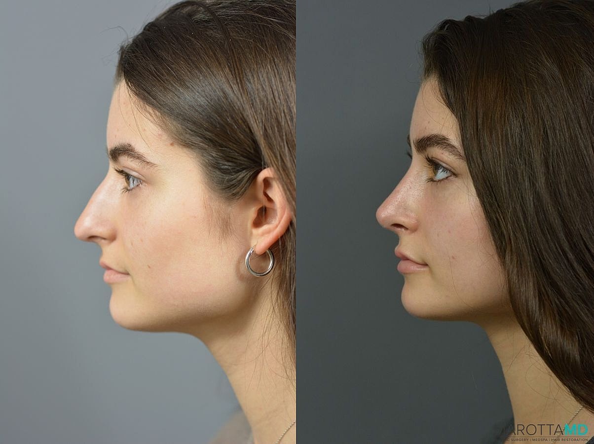 Nose Surgery Before & After