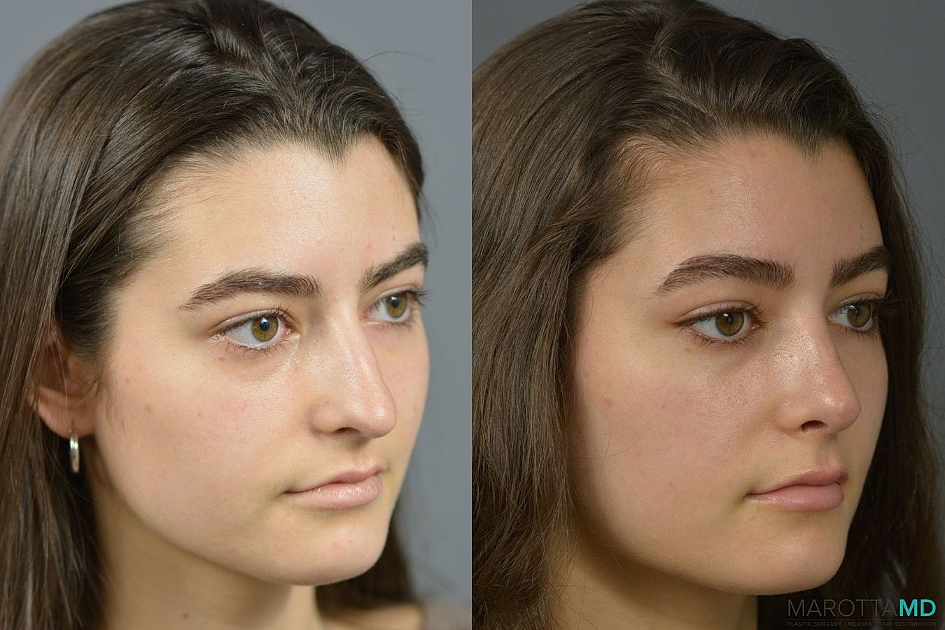 Nose Surgery Before & After