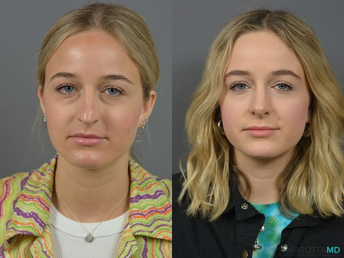 Nose Surgery Before & After