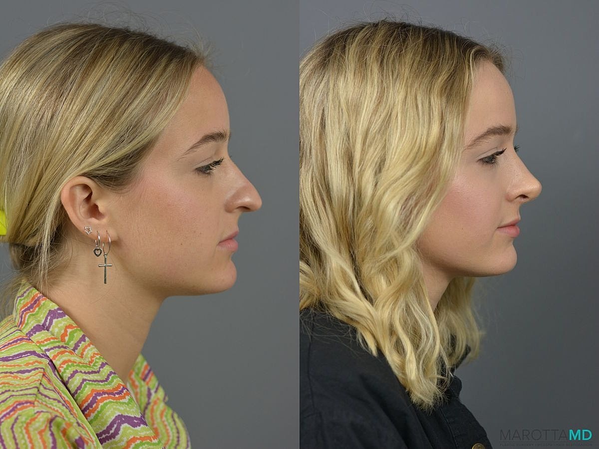 Nose Surgery Before & After