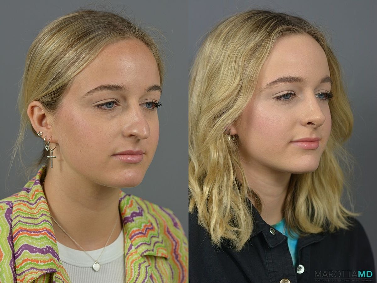 Nose Surgery Before & After