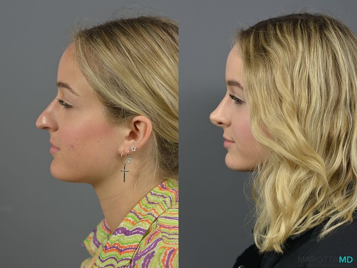 Nose Surgery Before & After