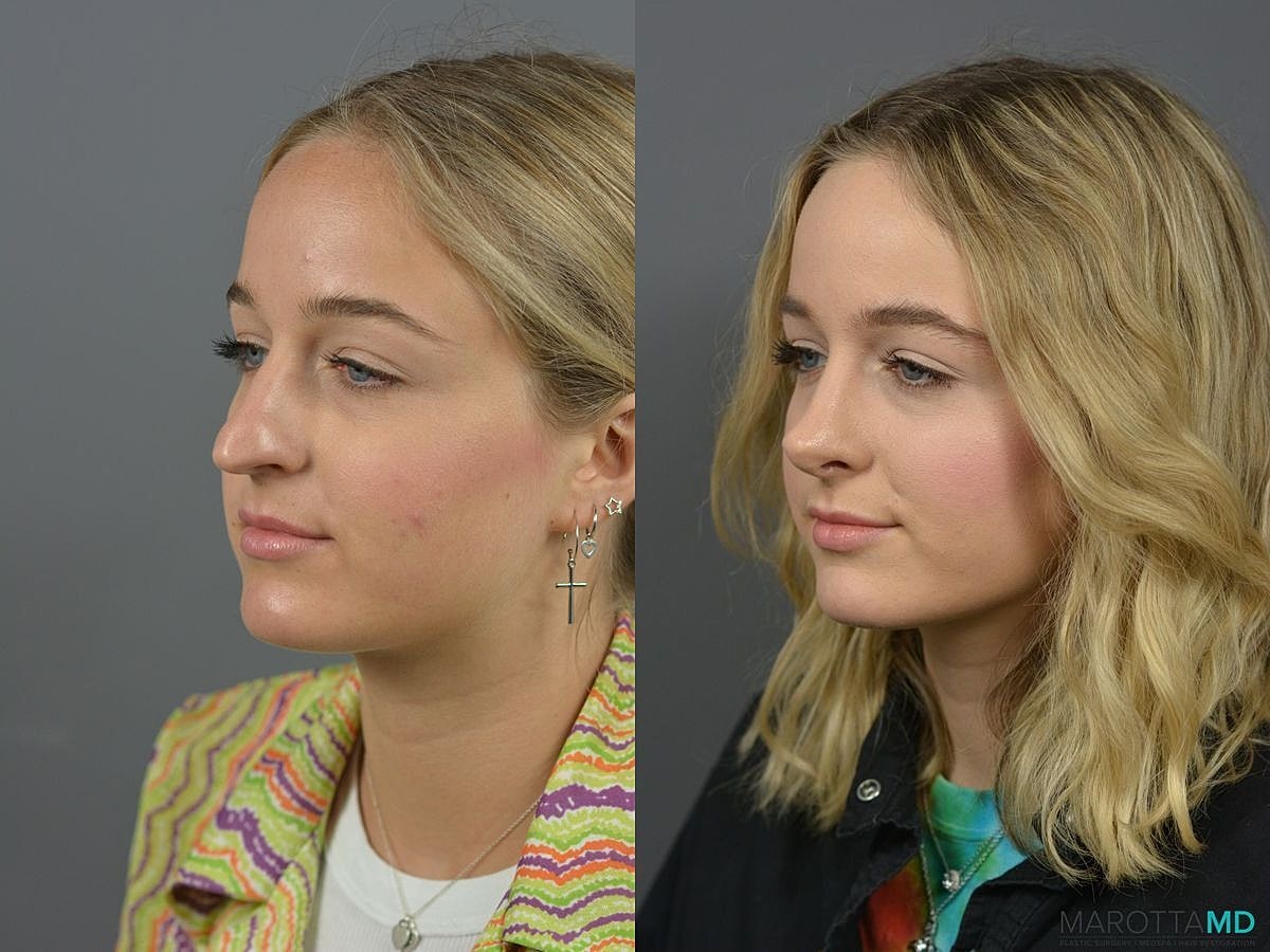 Nose Surgery Before & After