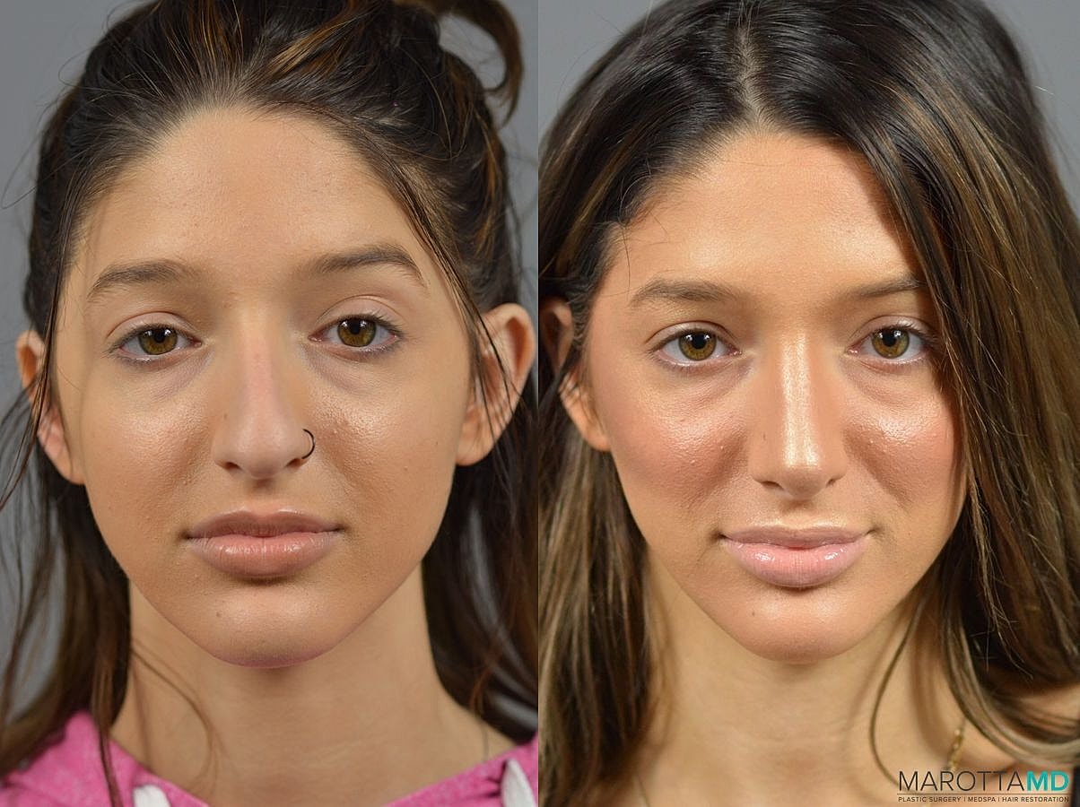 Nose Surgery Before & After