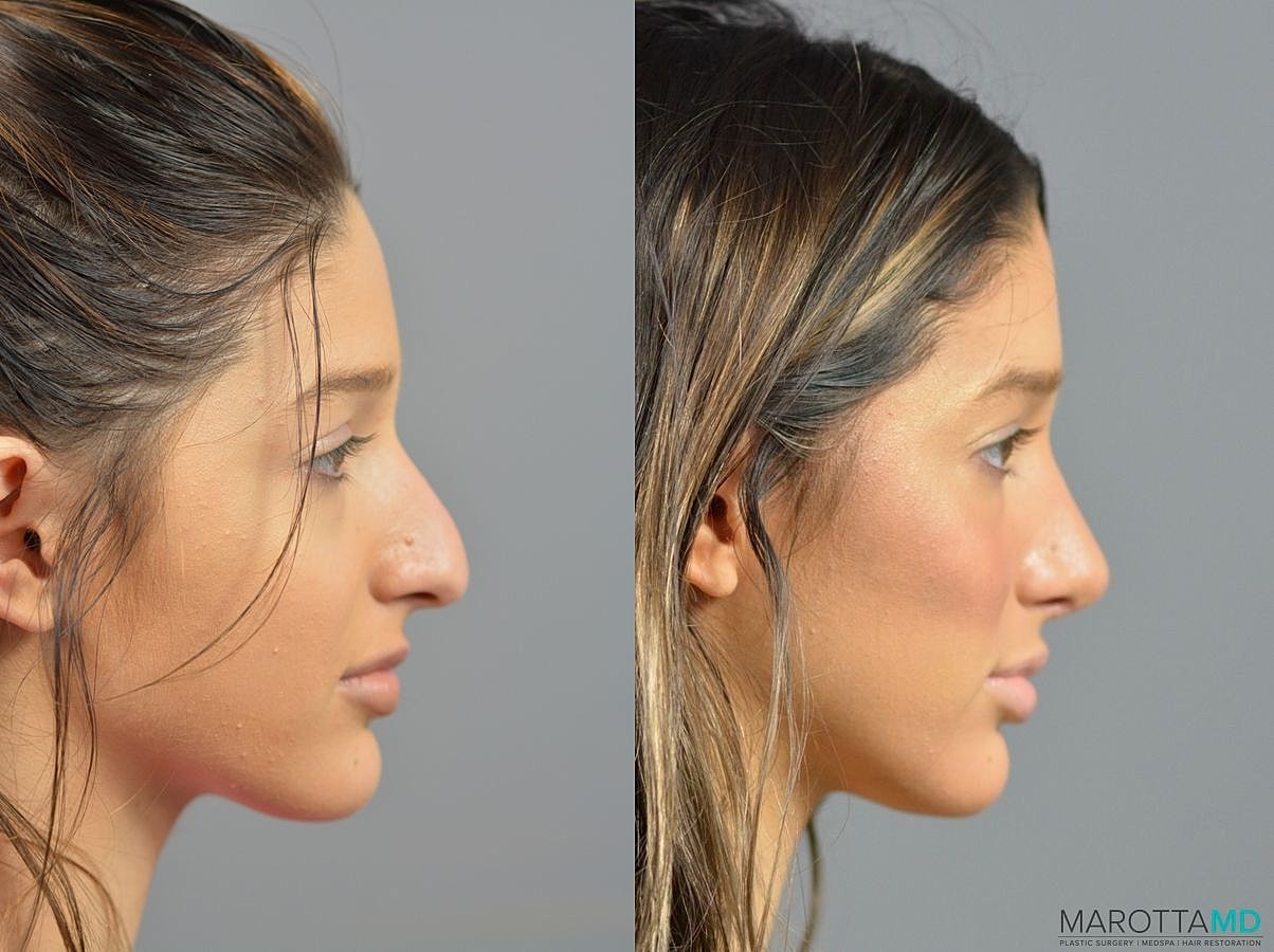 Nose Surgery Before & After