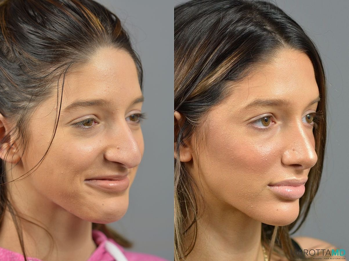 Nose Surgery Before & After