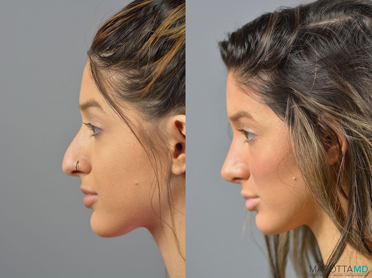 Nose Surgery Before & After