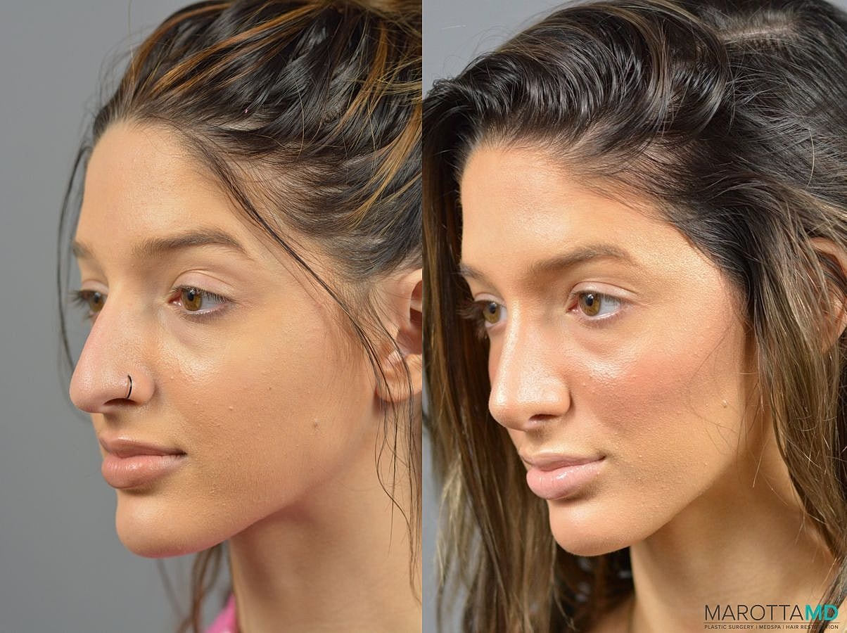 Nose Surgery Before & After