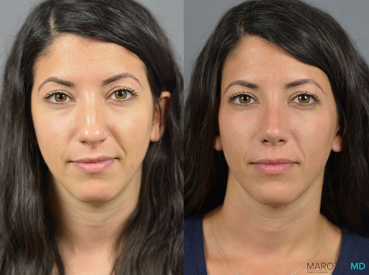 Nose Surgery Before & After