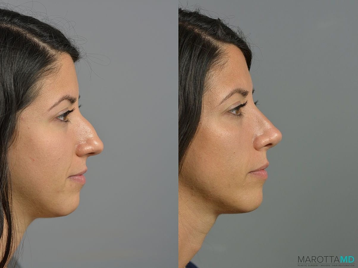 Nose Surgery Before & After