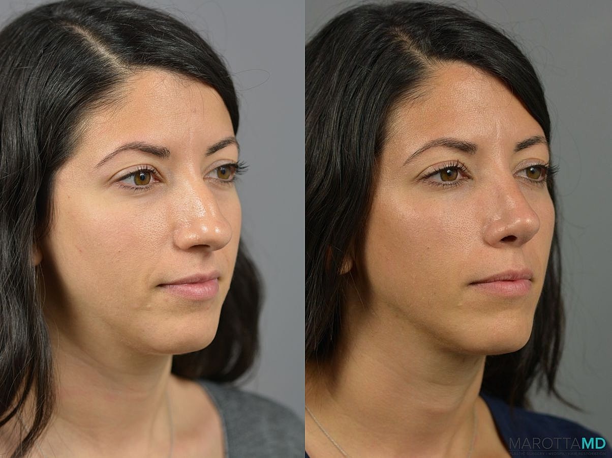Nose Surgery Before & After