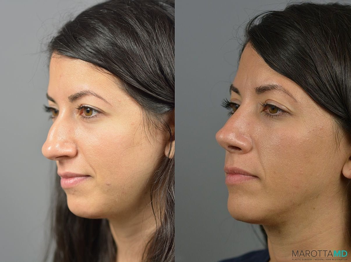 Nose Surgery Before & After