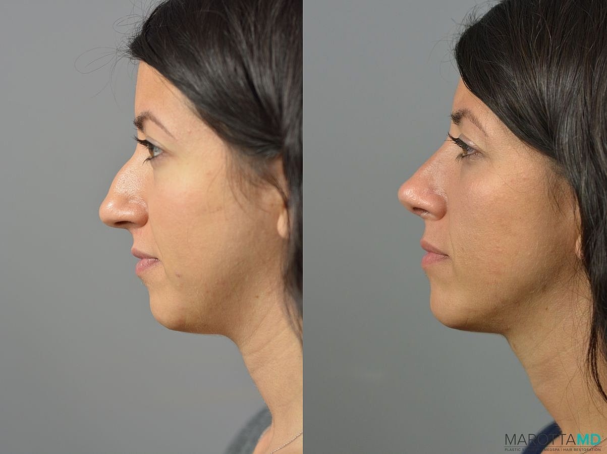 Nose Surgery Before & After