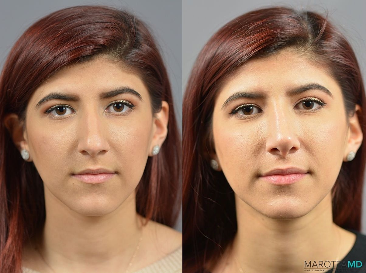 Nose Surgery Before & After