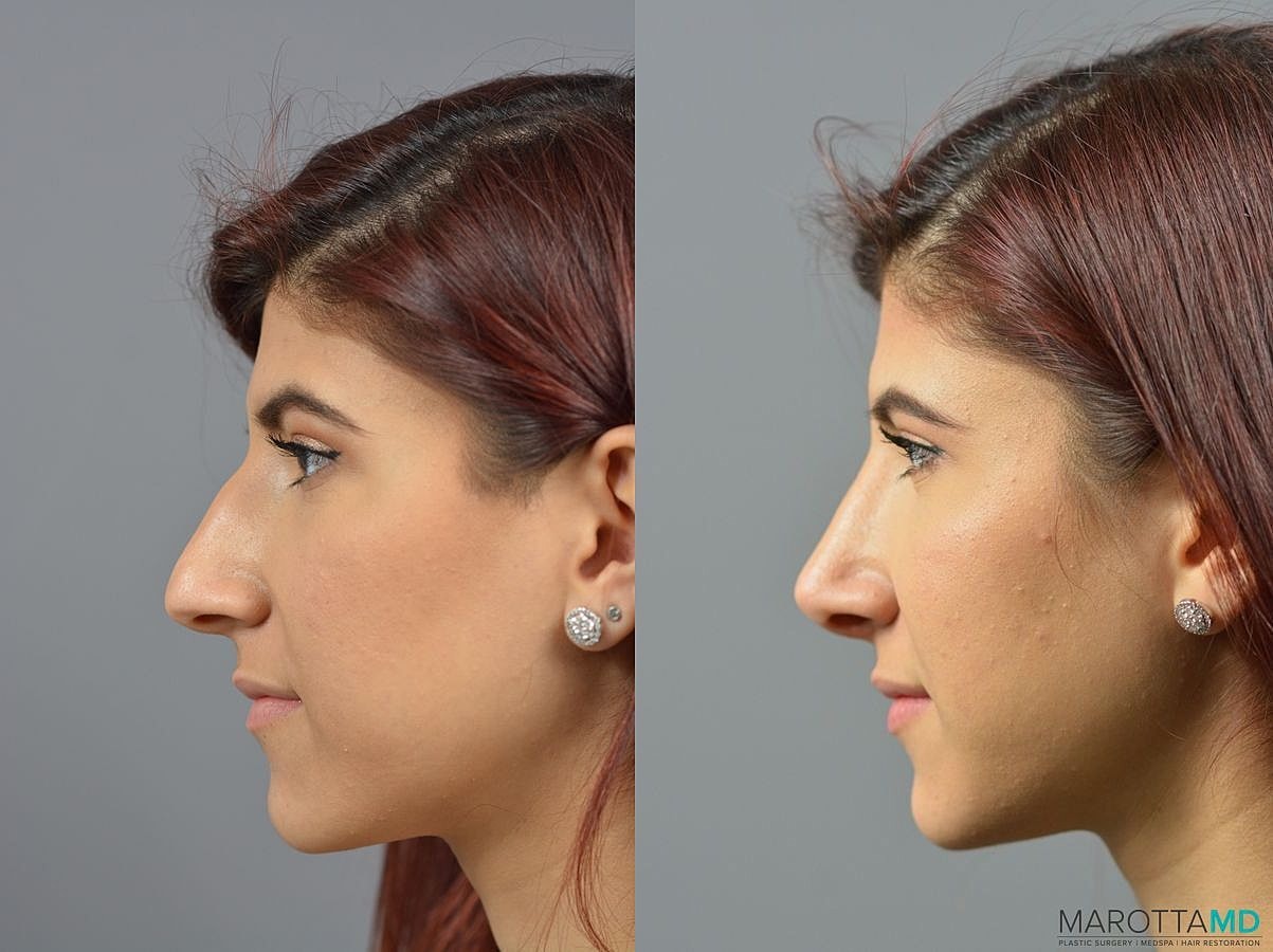 Nose Surgery Before & After