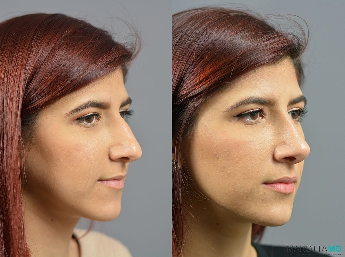 Nose Surgery Before & After