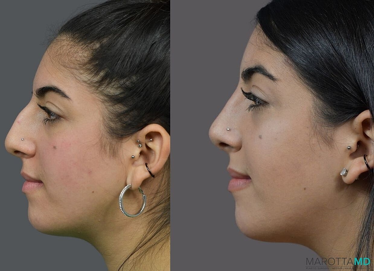 Nose Surgery Before & After