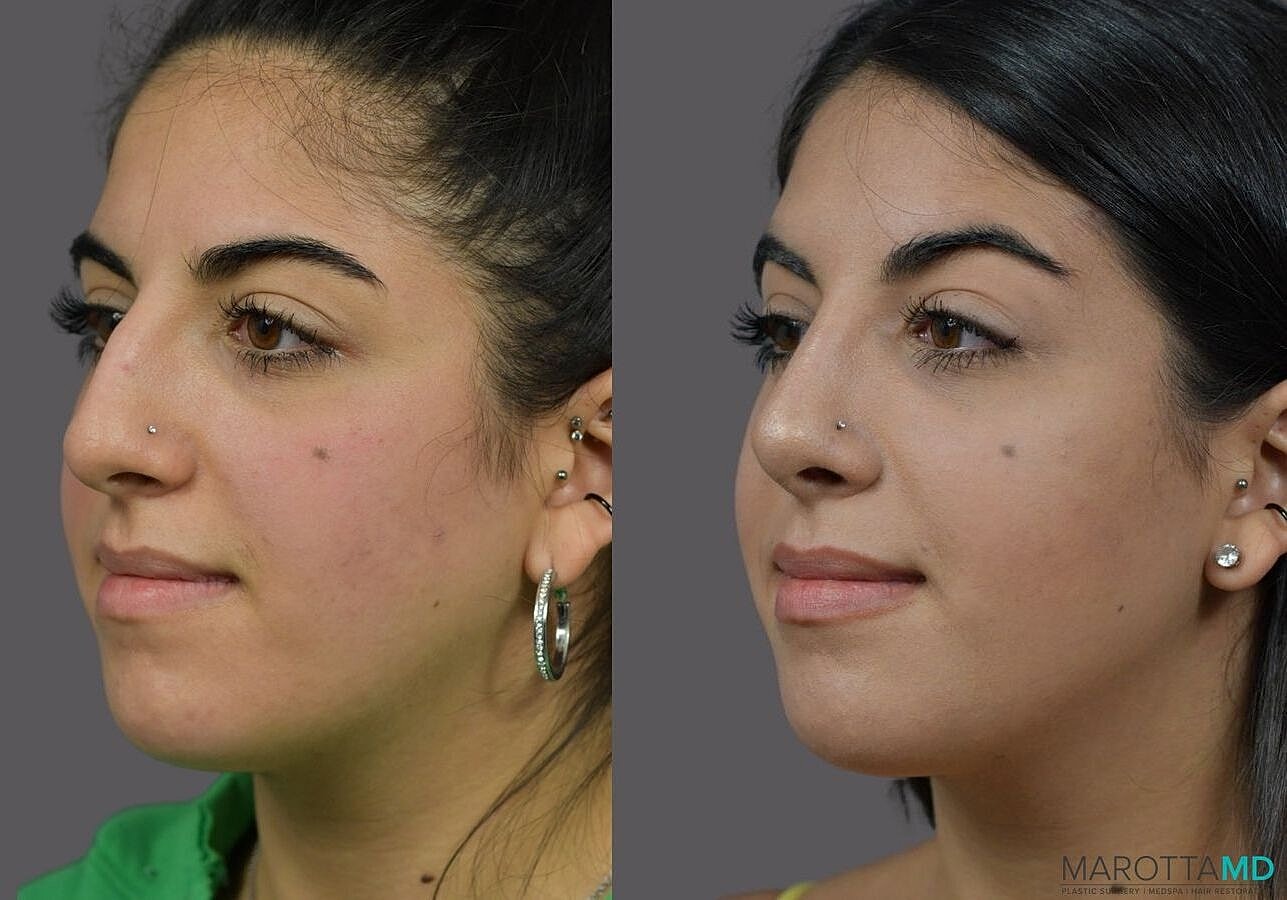 Nose Surgery Before & After