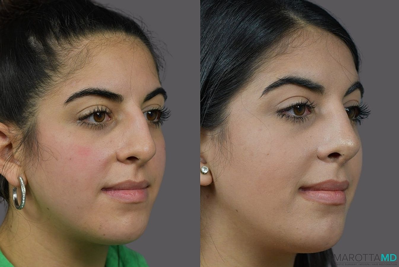 Nose Surgery Before & After