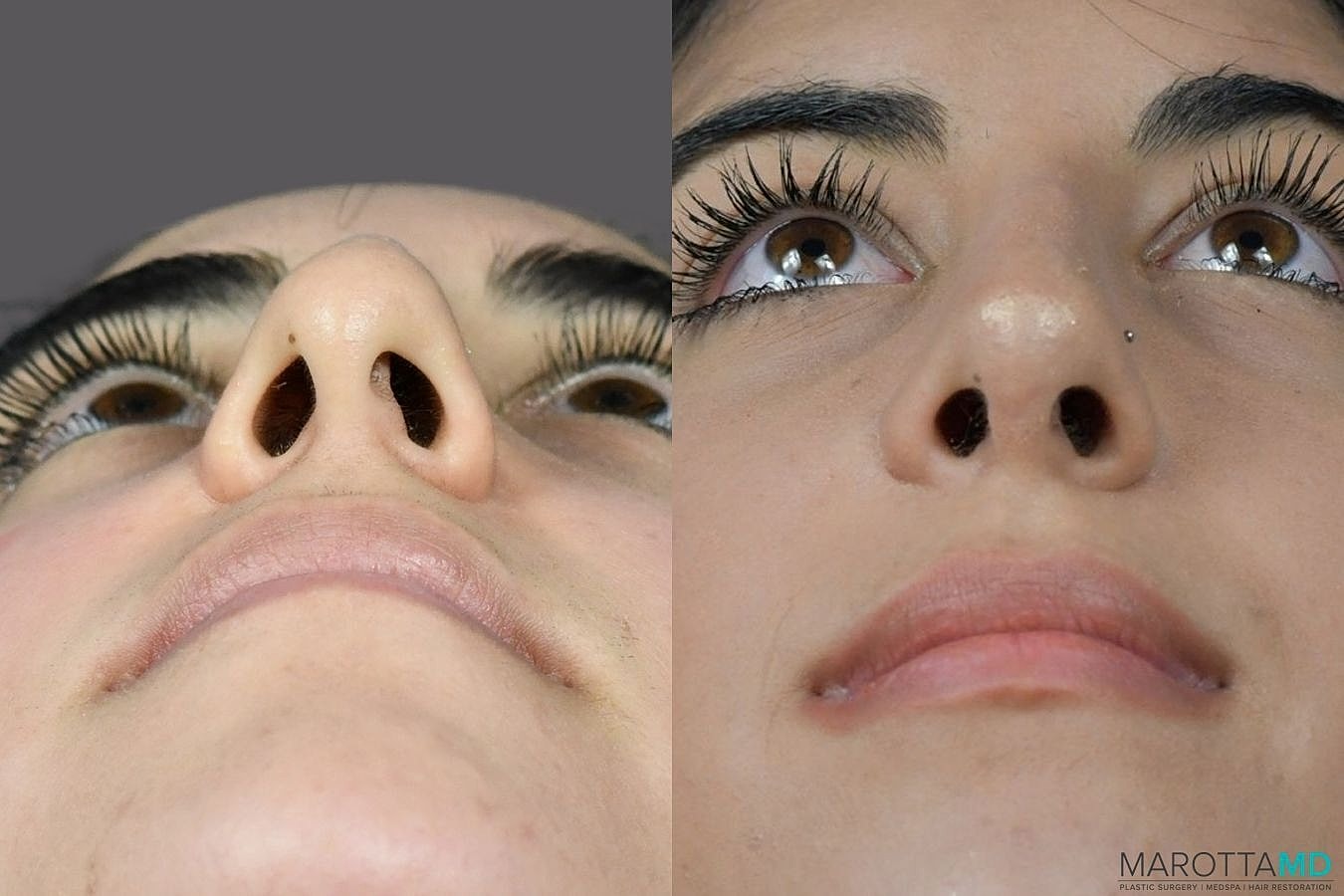 Nose Surgery Before & After