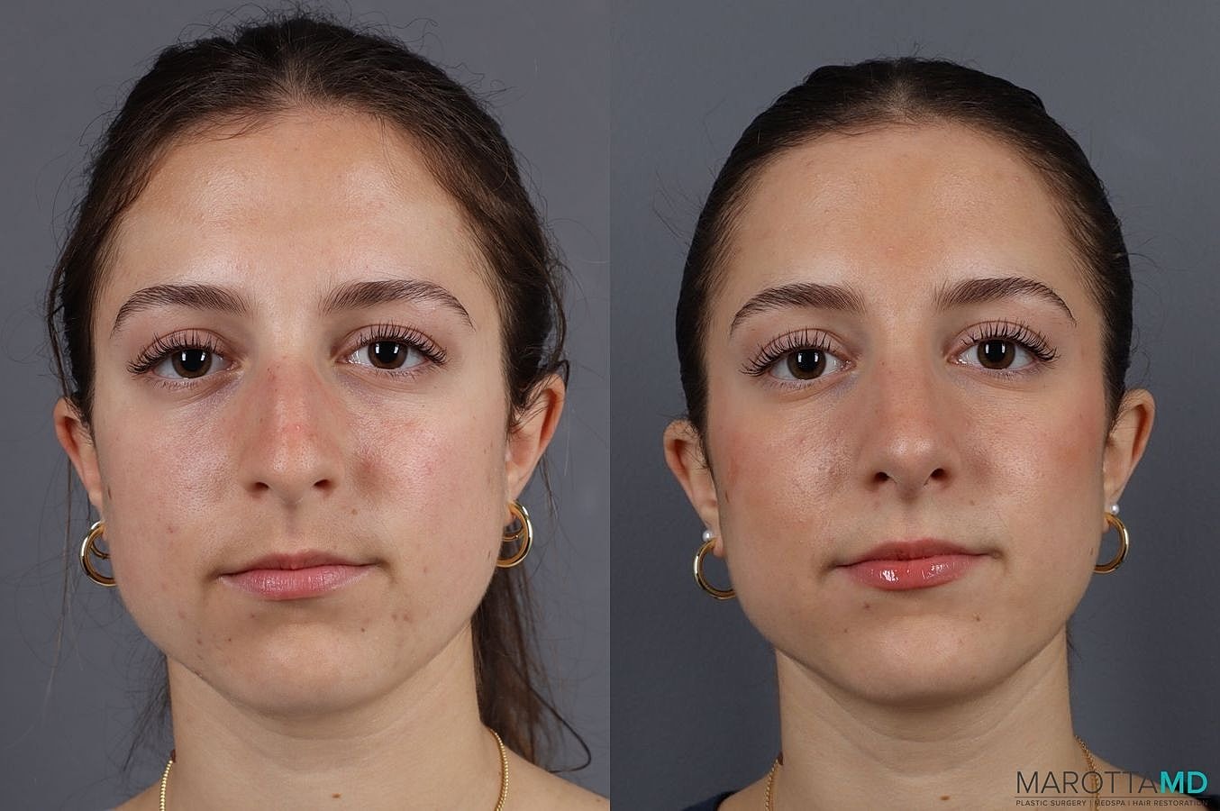 Nose Surgery Before & After