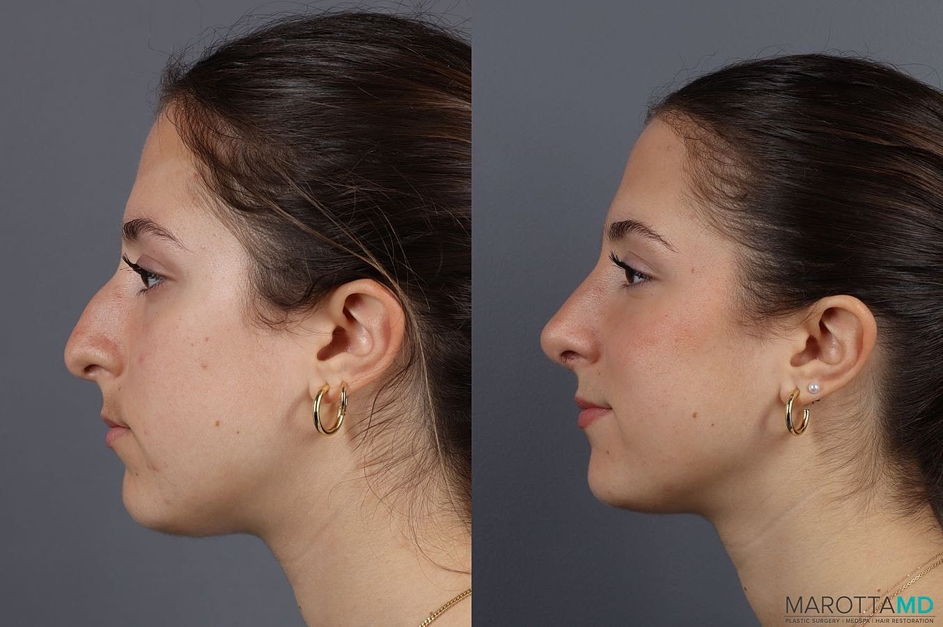 Nose Surgery Before & After
