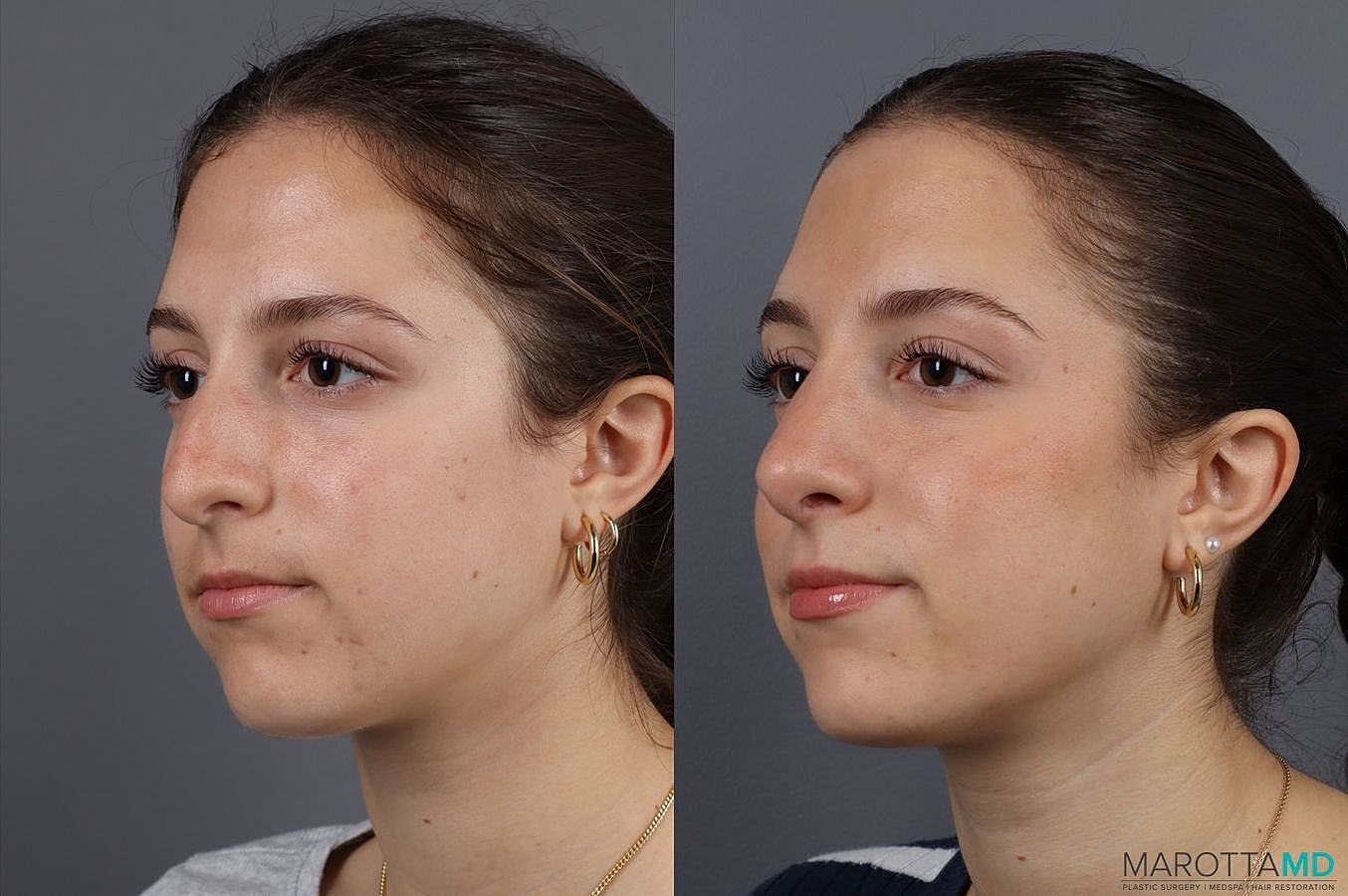 Nose Surgery Before & After