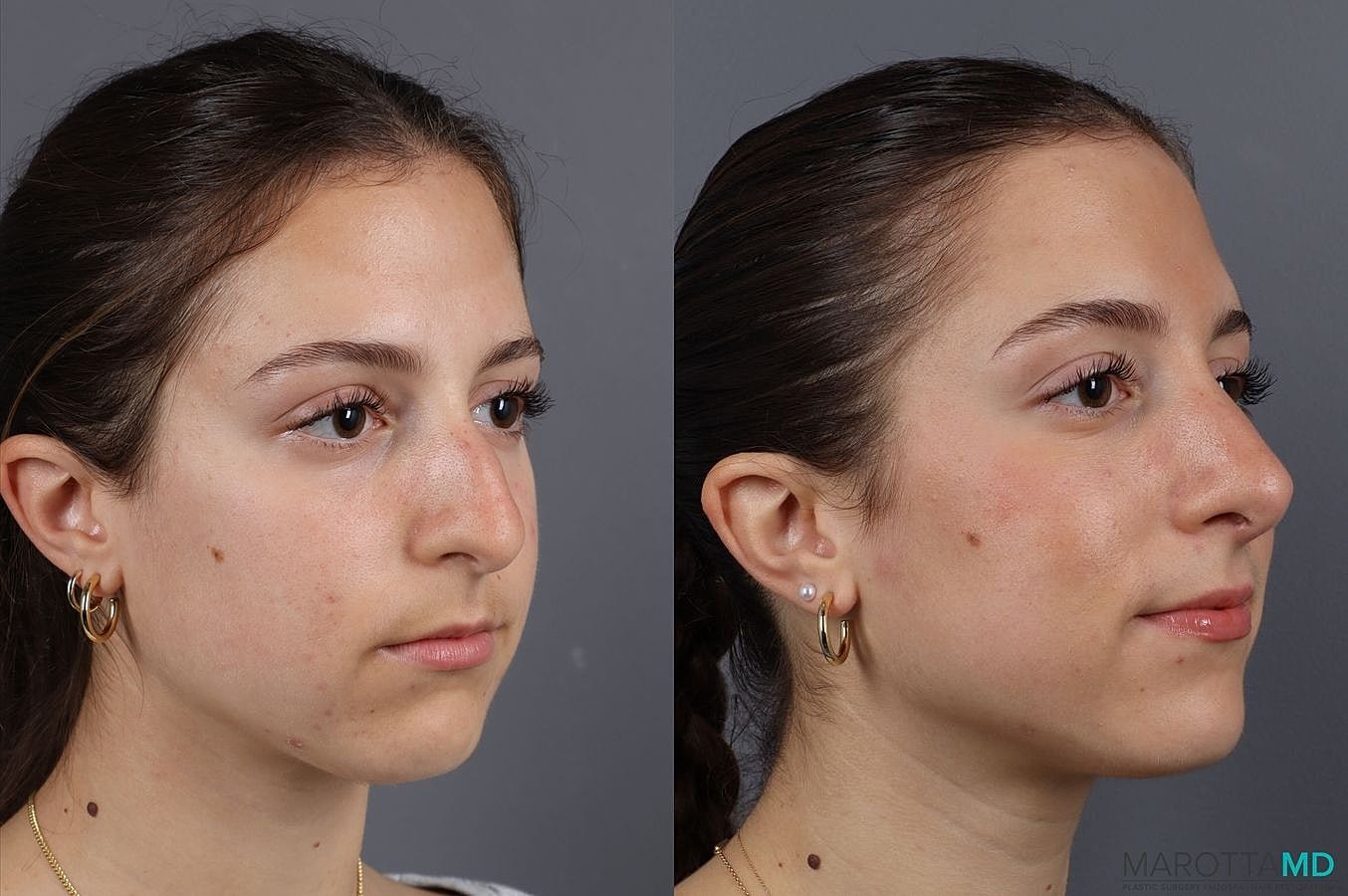 Nose Surgery Before & After