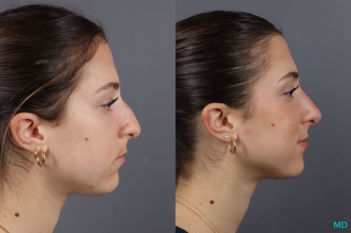 Nose Surgery Before & After