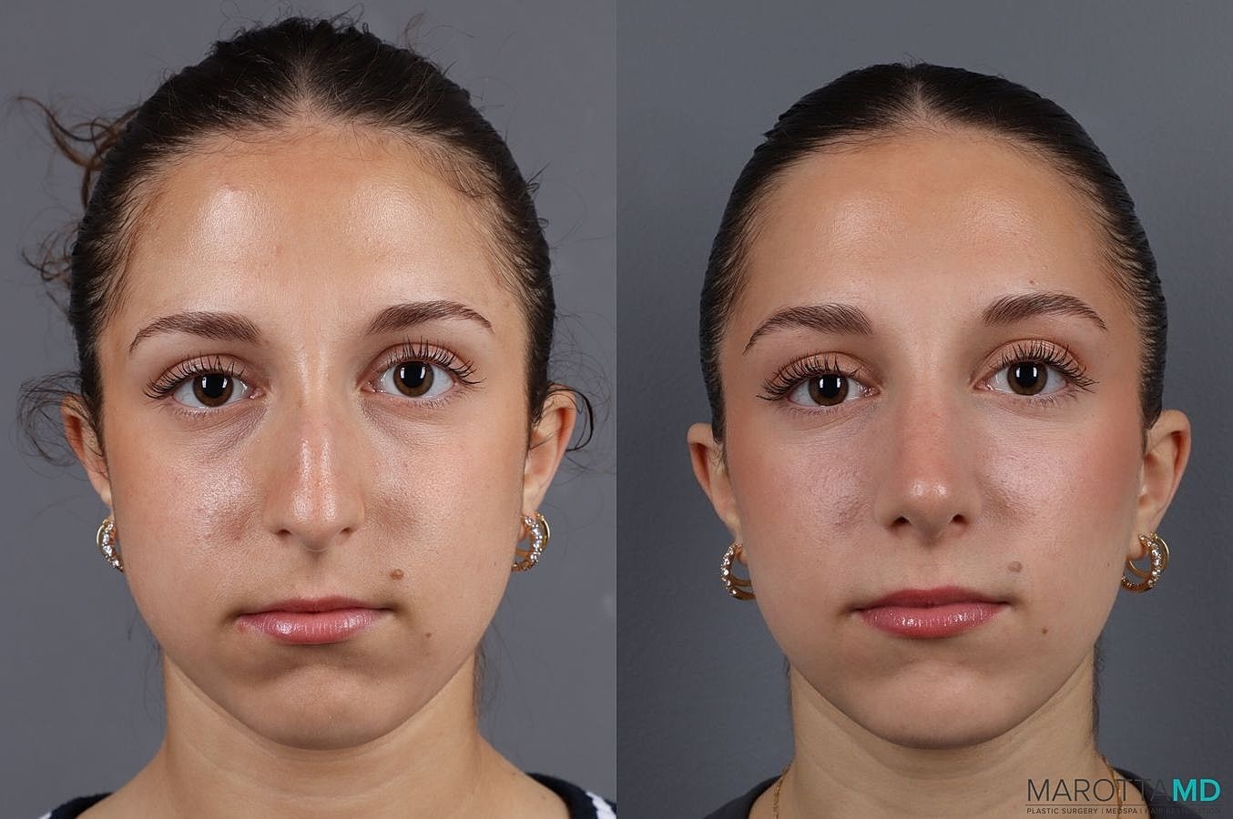 Nose Surgery Before & After