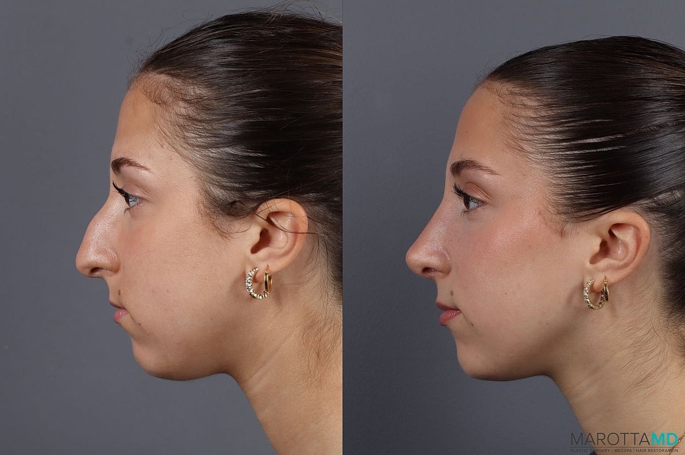 Nose Surgery Before & After