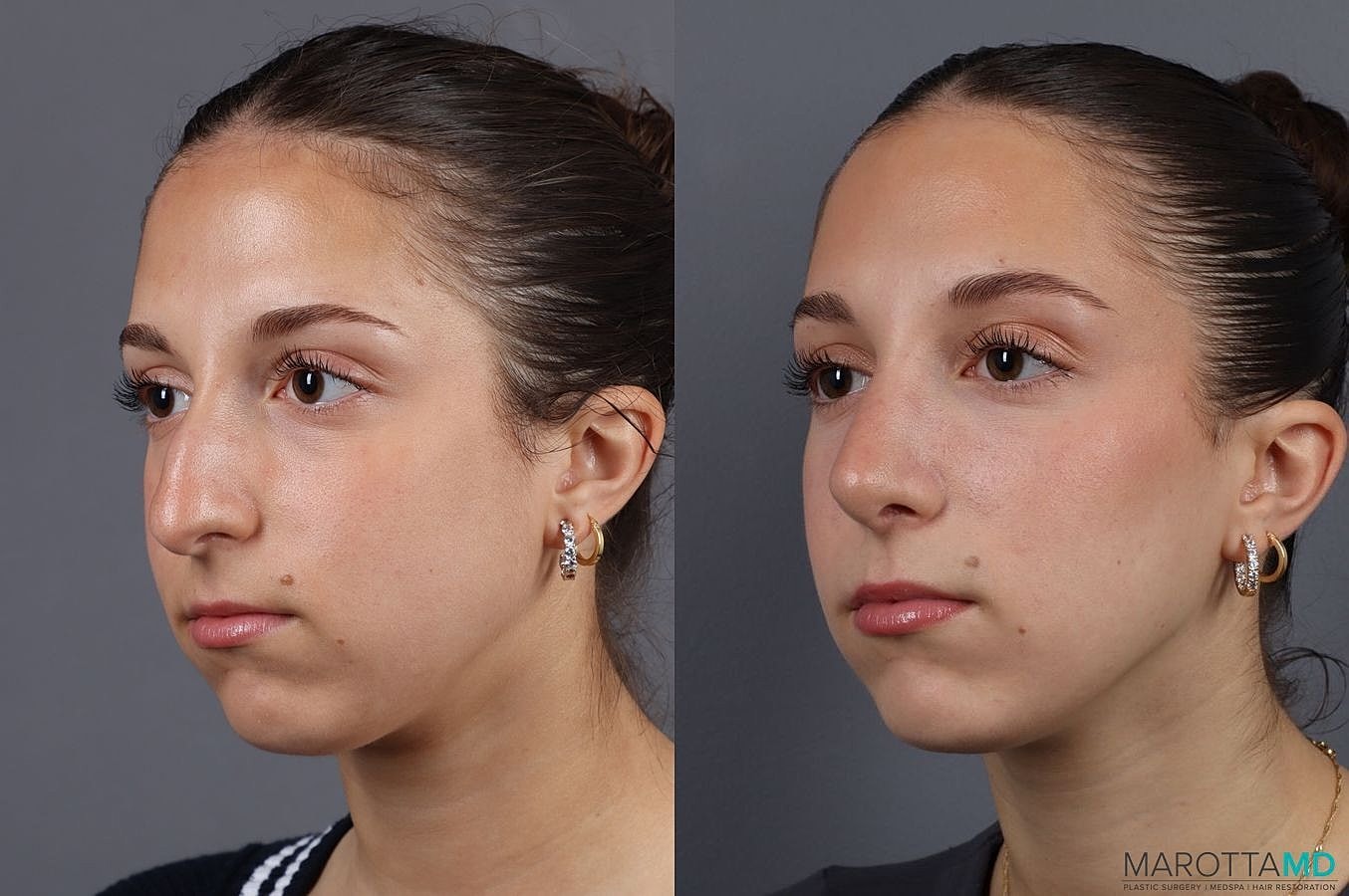 Nose Surgery Before & After