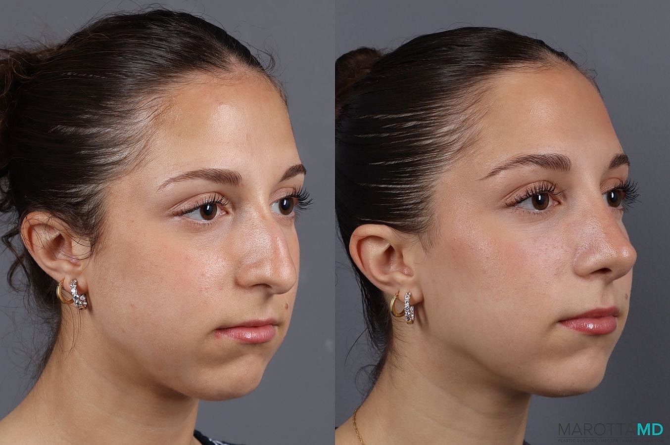 Nose Surgery Before & After