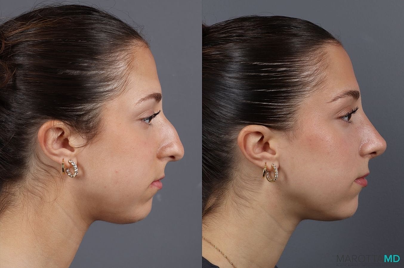 Nose Surgery Before & After
