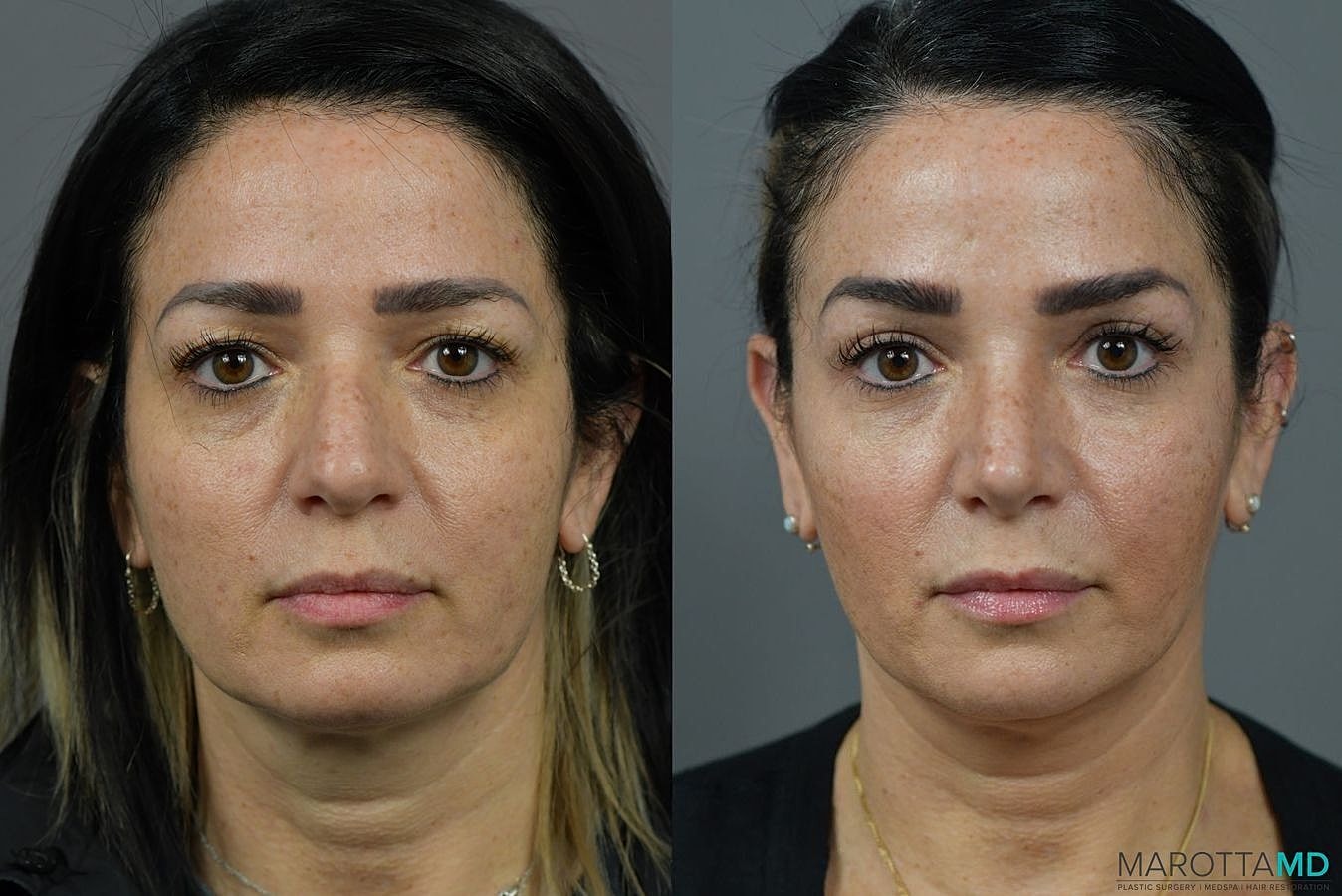 Nose Surgery Before & After