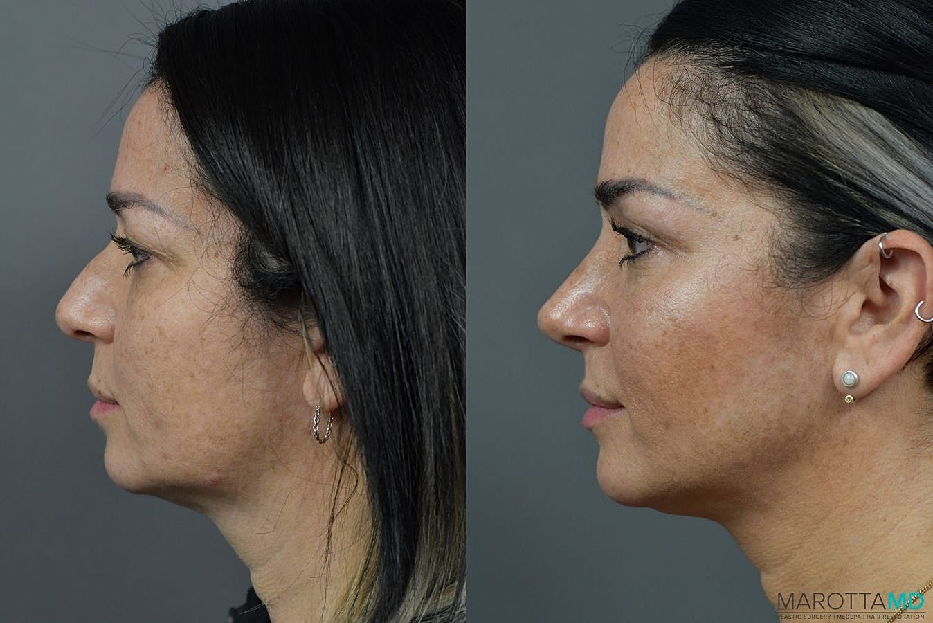 Nose Surgery Before & After